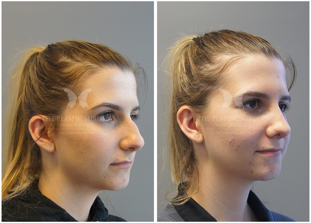 Young female patient before and after rhinoplasty surgery at The Plastic Surgery Clinic 05