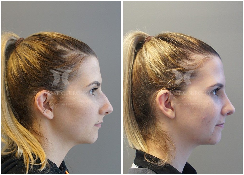 Nose job before and after 06, side view, Dr Reddy Sydney