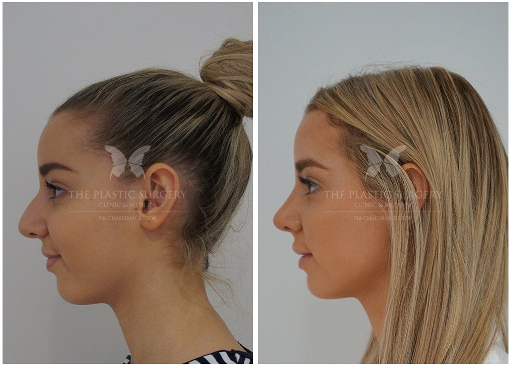Before and after Rhinoplasty cosmetic nose surgery 09, young female patient, side view