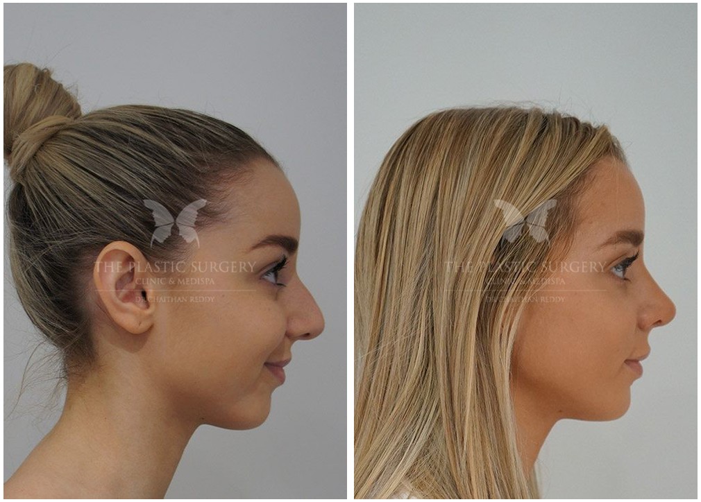 Nose job surgery, before and after 11, right side view