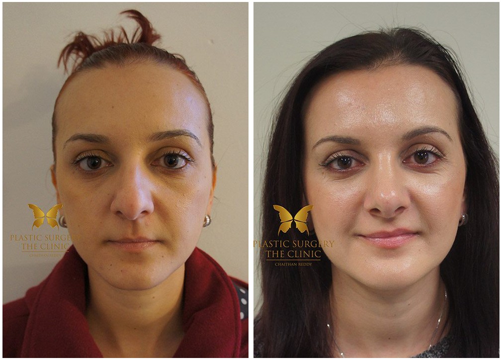 Rhinoplasty results 12, female patient, front view