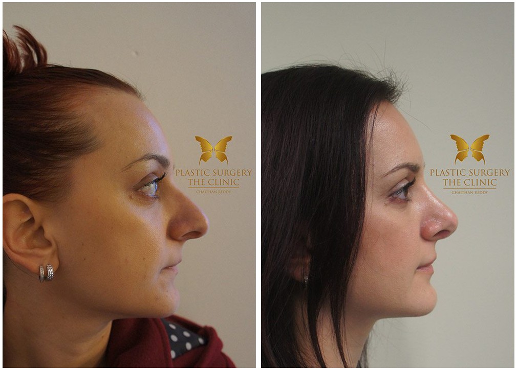 Female patient, before and after nose job 15, Dr Chaithan Reddy