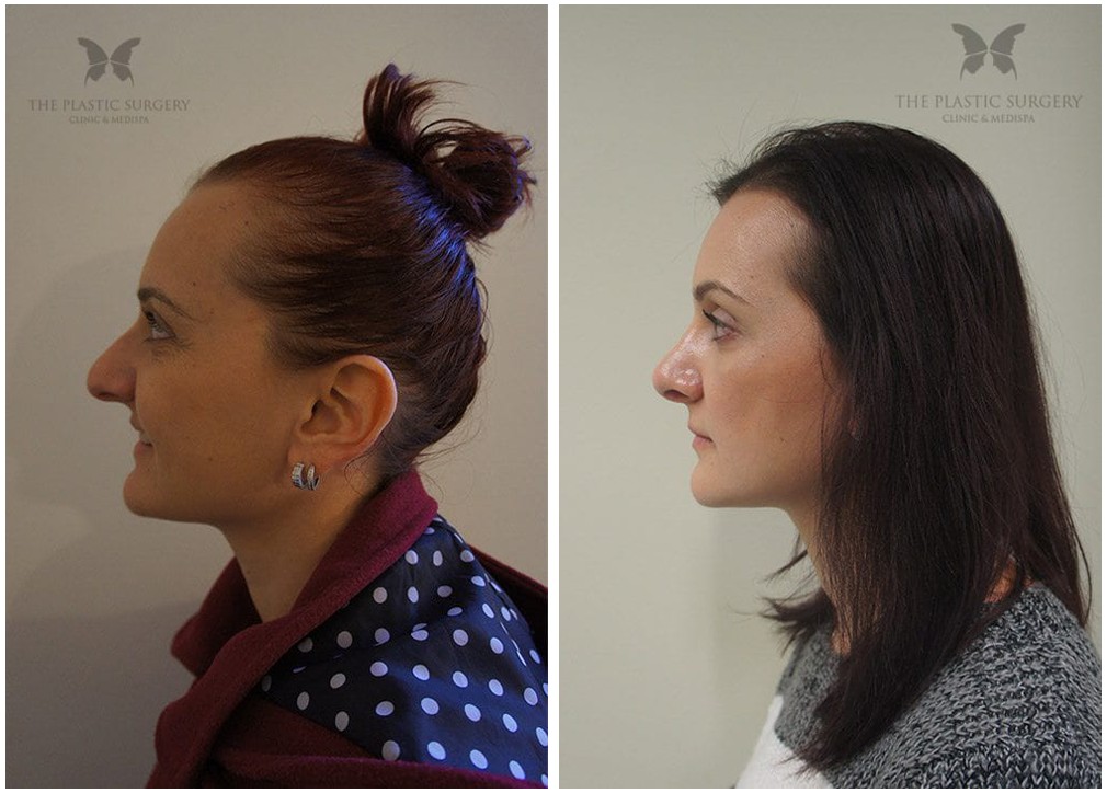 Results after Rhinoplasty surgery 16, The Plastic Surgery Clinic