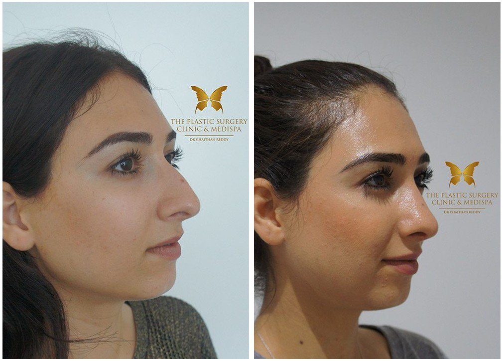 Nose job surgery results 24, Dr Chaithan Reddy