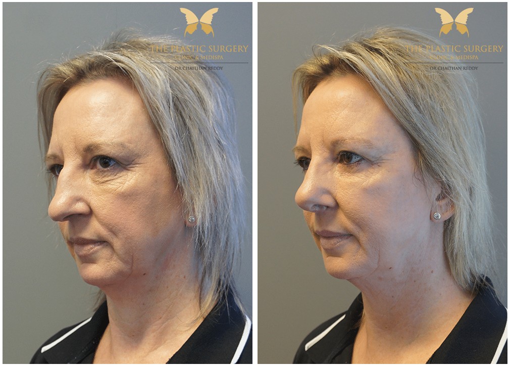 Before and after Rhinoplasty surgery 29, The Plastic Surgery Clinic