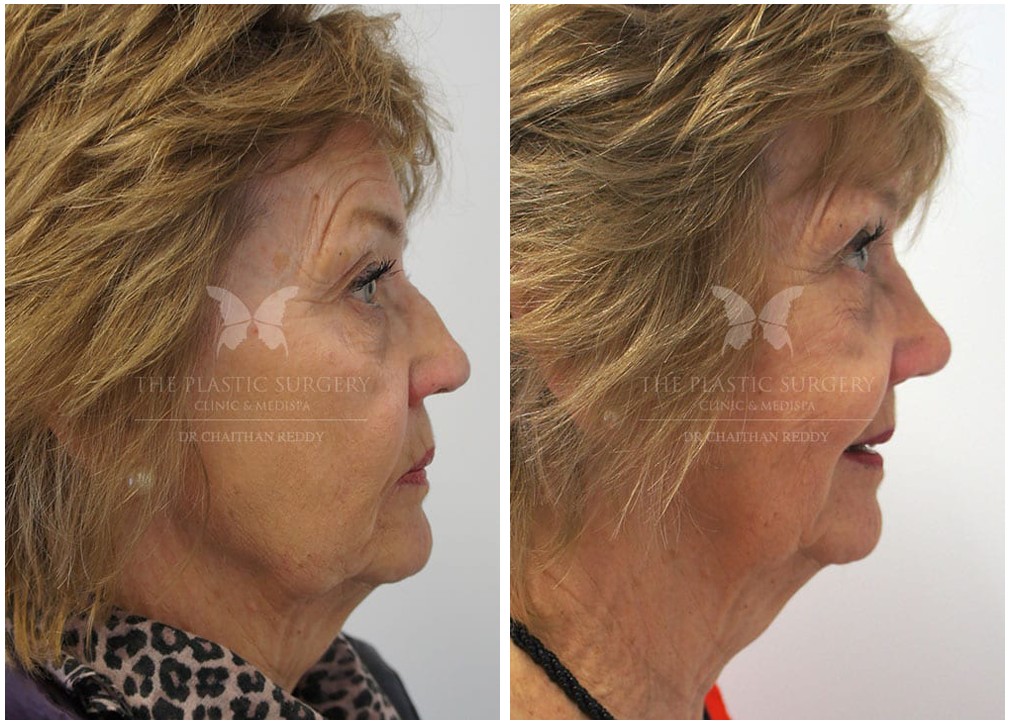 Before and after rhinoplasty 35, Dr Chaithan Reddy
