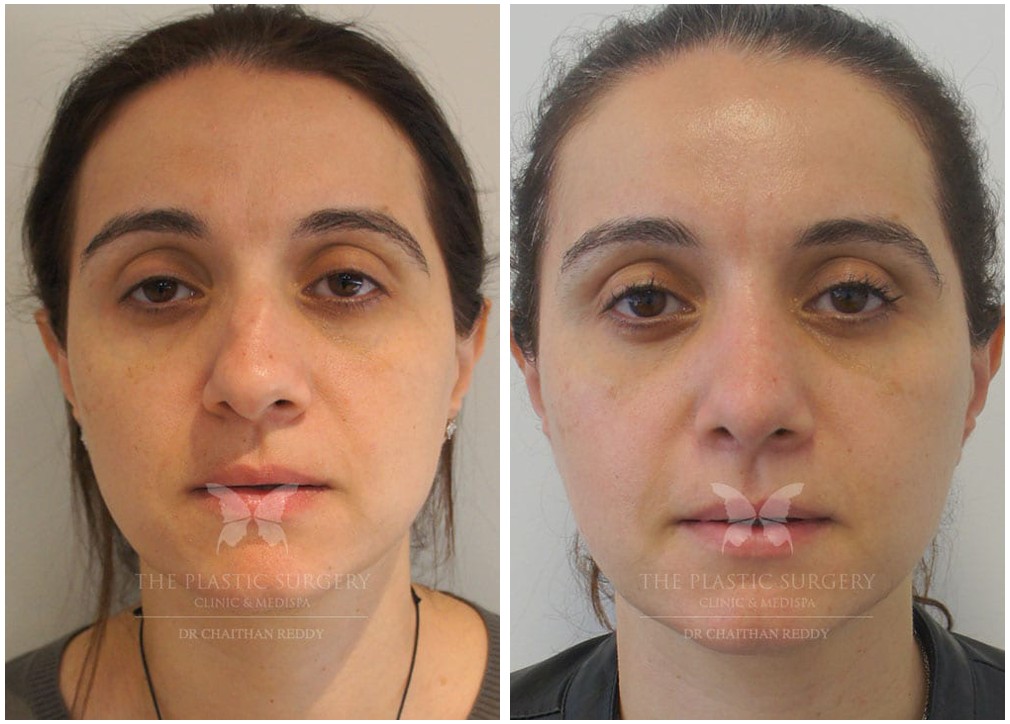 Nose job patient before and after surgery 36, TPSC