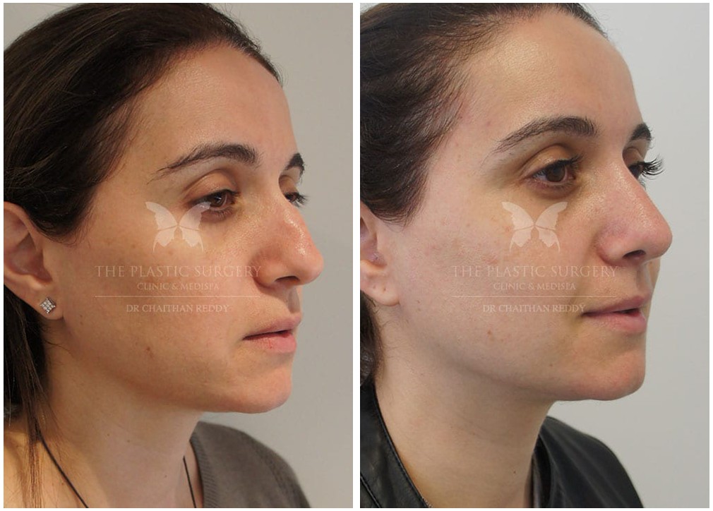 Before and afters 37, nose job surgery, Dr Chaithan Reddy