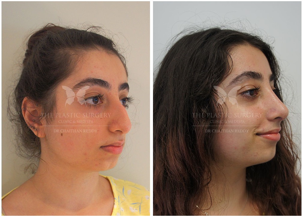 Nose job before and after 39, TPSC Sydney &amp; Central Coast