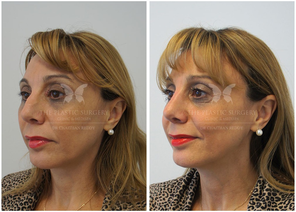 Before and after cosmetic nose surgery 45, Dr Chaithan Reddy