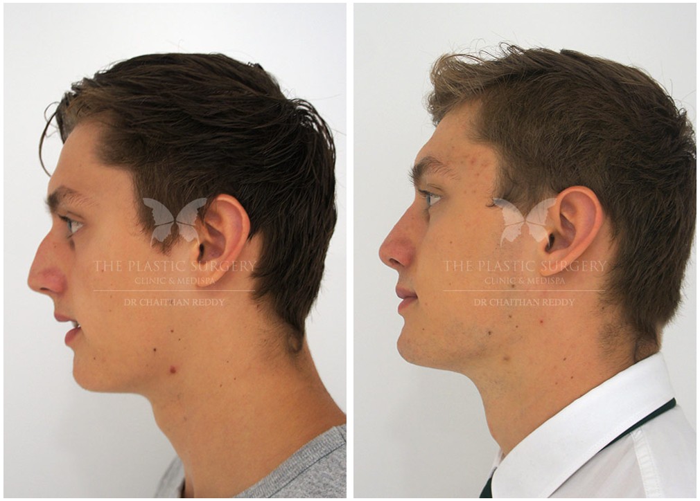 Male patient before and after nose job 54, Dr Reddy
