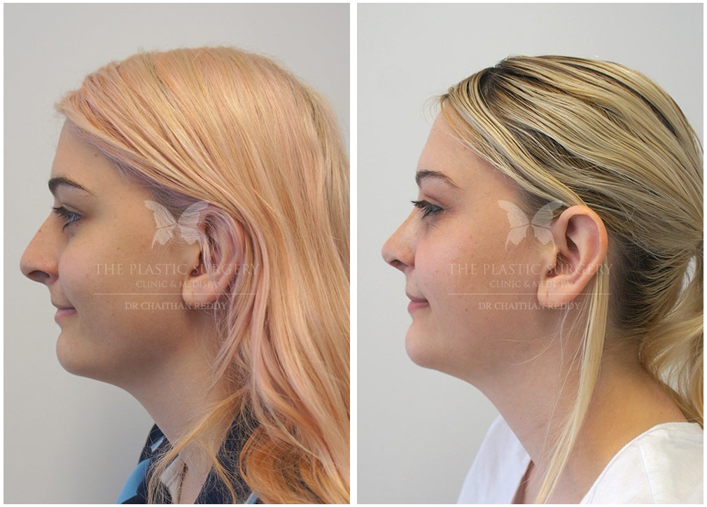 Young female patient before and after Rhinoplasty 55, TPSC
