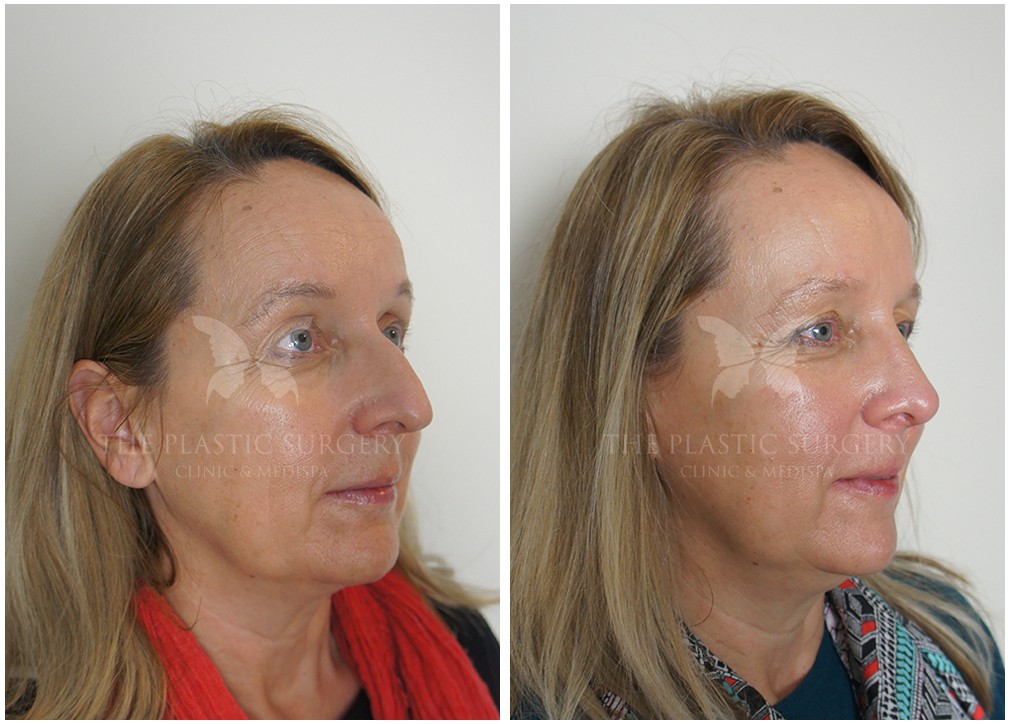 Patient before and after Rhinoplasty 58