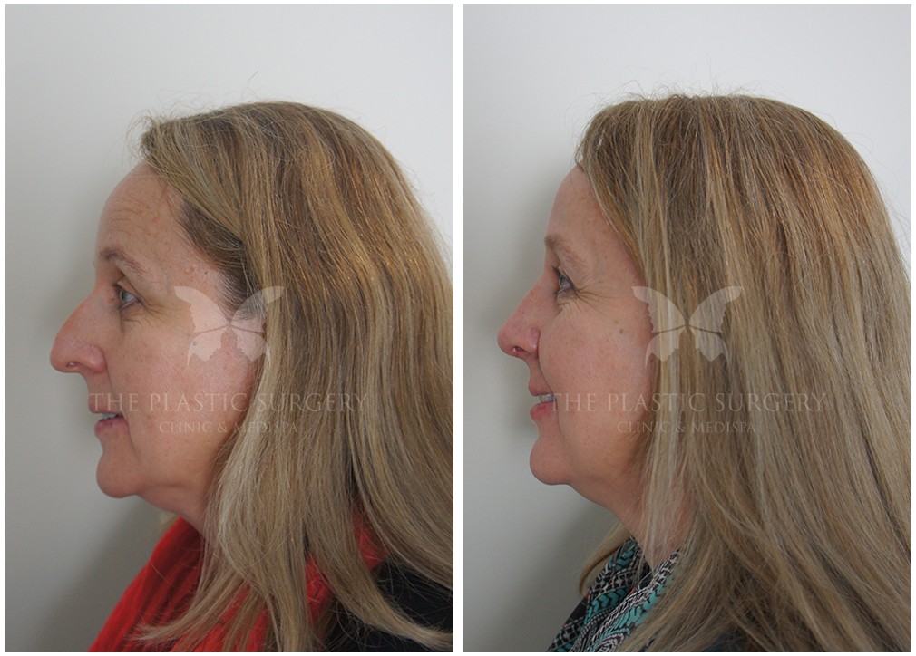 Female patient before and after 60, TPSC Sydney &amp; Central Coast