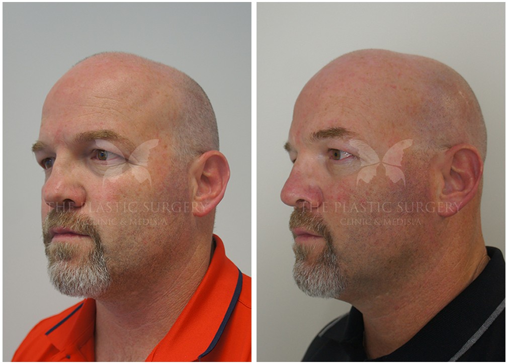 Male patient before and after nose job 63, TPSC
