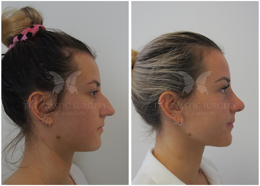 Rhinoplasty surgery results 64, female patient, side view