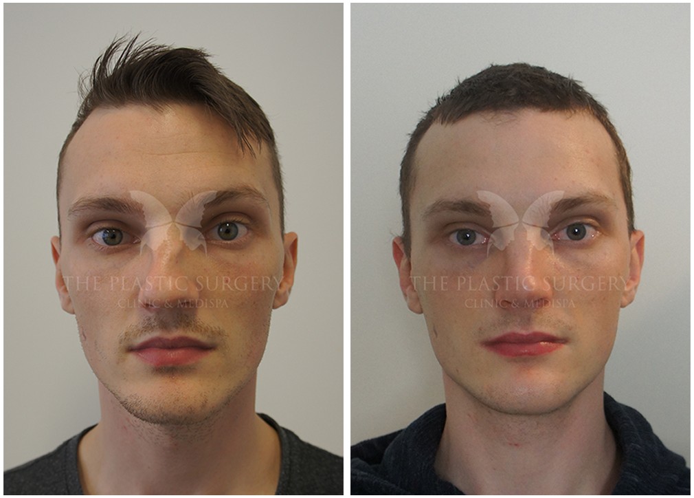 Male patient after successful nose job surgery 72, TPSC
