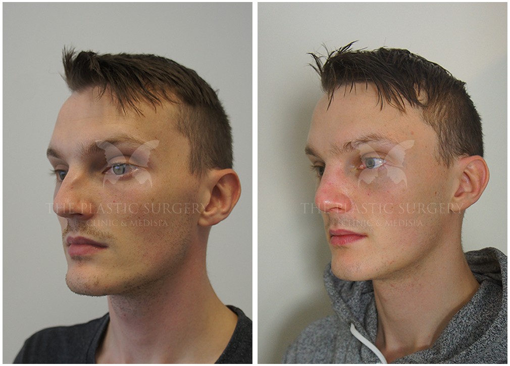 Nose job surgery, before and afters 75, Dr Reddy