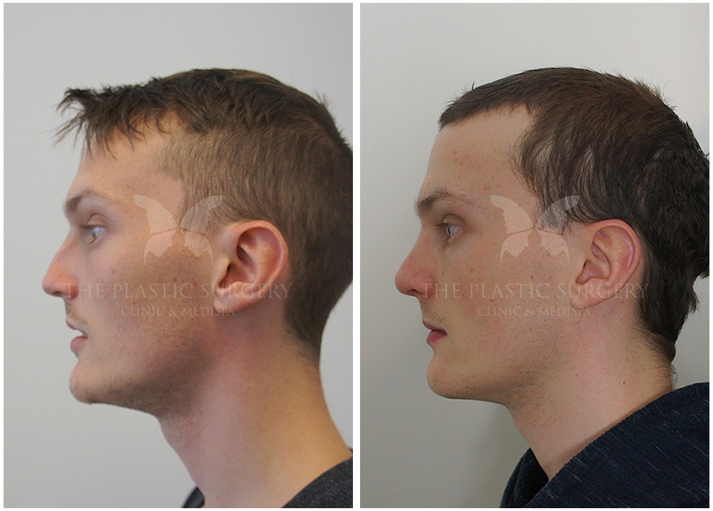 Nose job gallery, before and after 76, TPSC