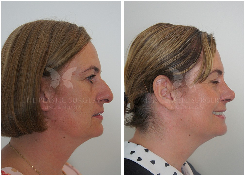 Before and after Rhinoplasty 77, female patient, side view