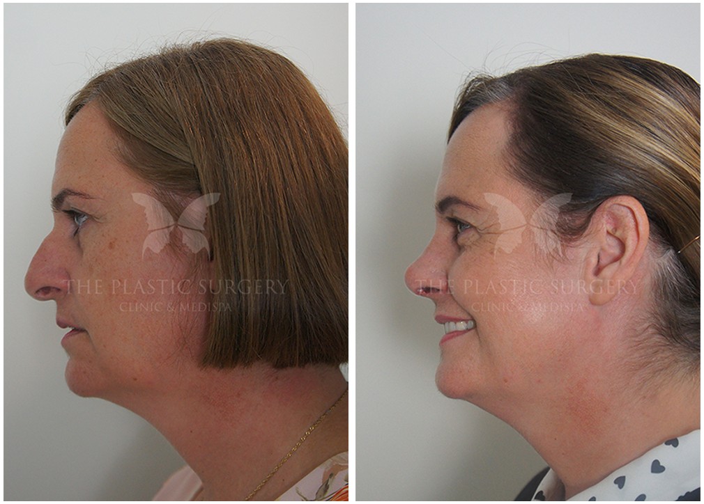 Rhinoplasty before and after 80, The Plastic Surgery Clinic