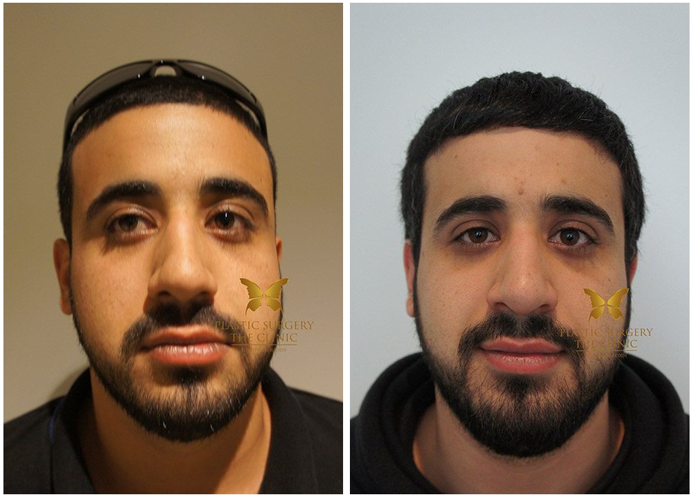 Before and after male Rhinoplasty, Dr Reddy, front view 14