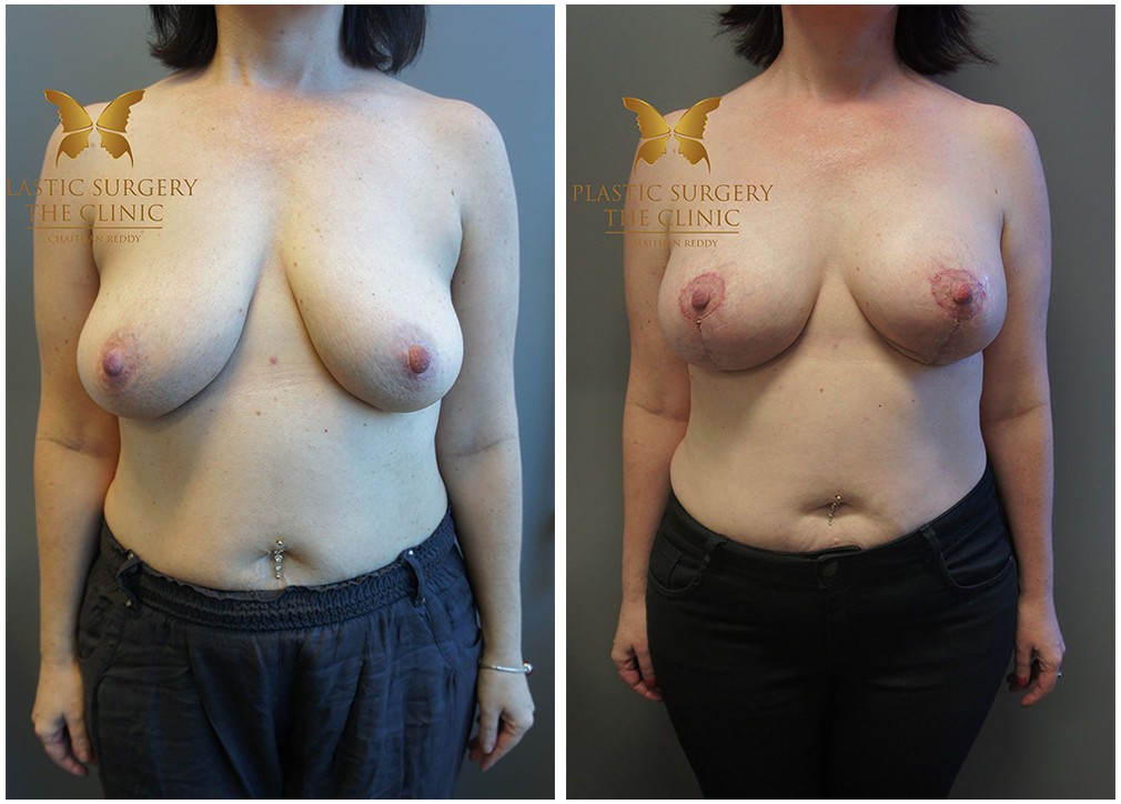 Breast implants and lift before and after 06, TPSC Sydney &amp; Central Coast