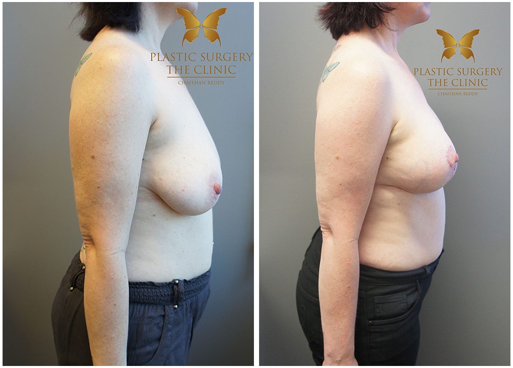 Breast augmentation Mastopexy surgery, before &amp; afters 07