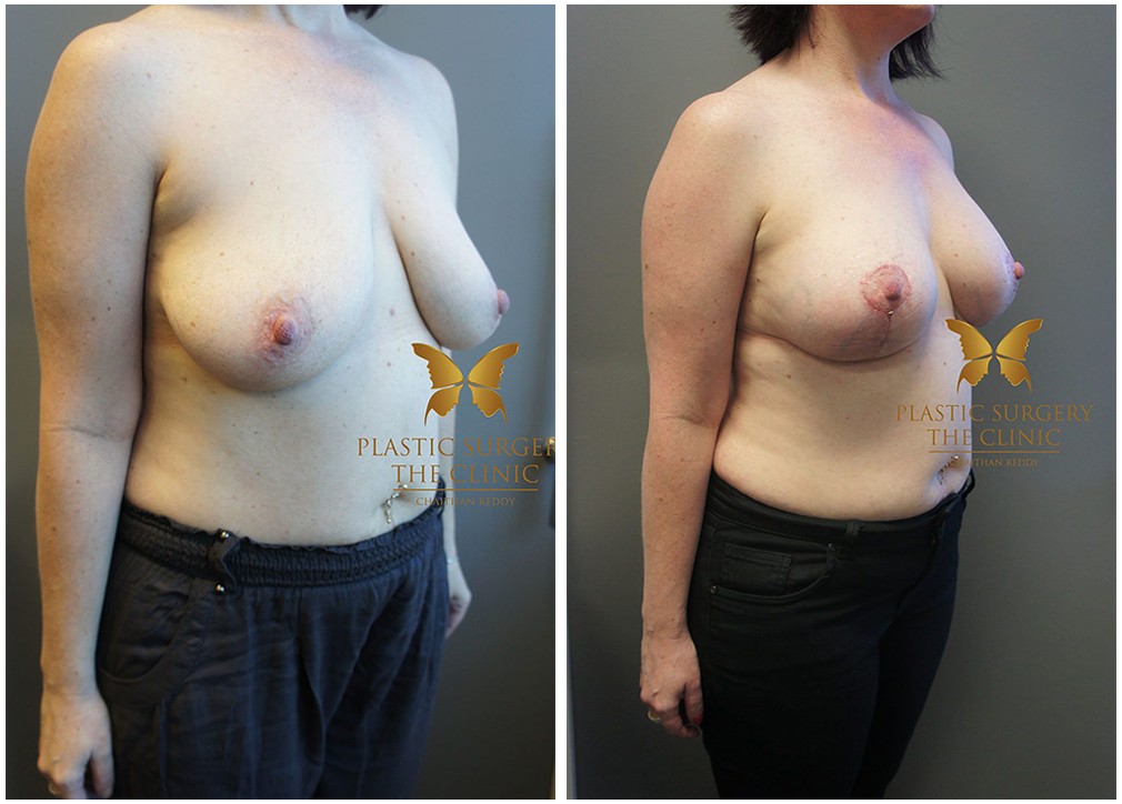 Patient before and after surgery 08, breast augmentation with lift, Dr Reddy