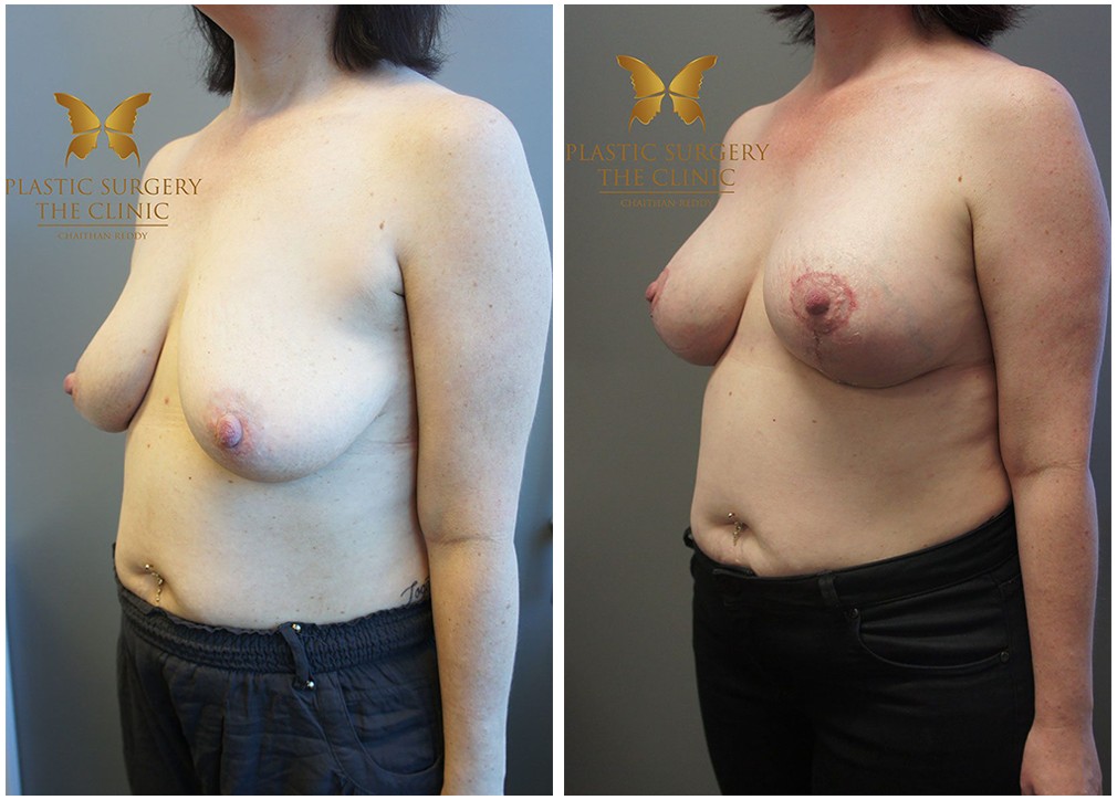 Breast augmentation and lift, patient before and after procedure (results) 09