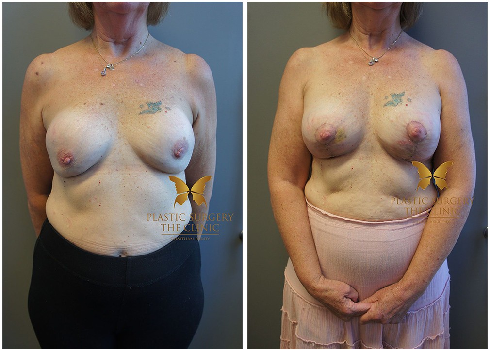 Breast augmentation and lift surgery results 10, TPSC