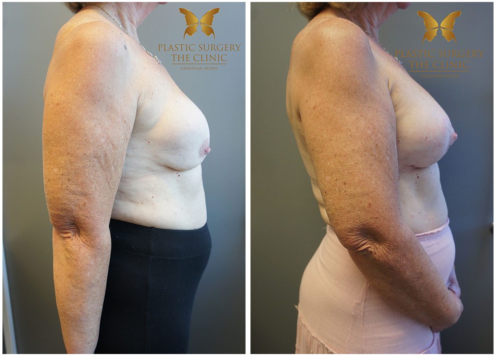 Breast augmentation and lift before and after 12, TPSC Sydney