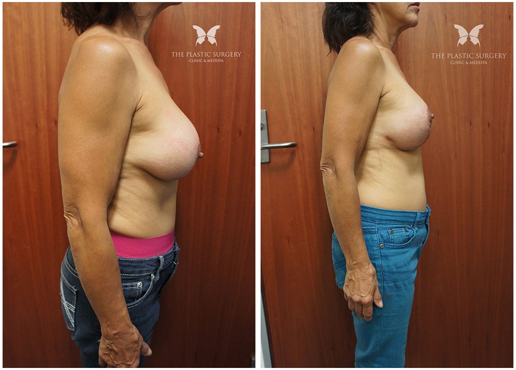 Breast augmentation and lift, before and after surgery 15, side view