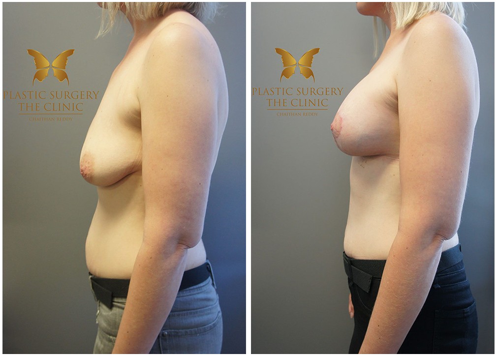 Side view, patient before and after 18, breast augmentation and lift, Dr Reddy