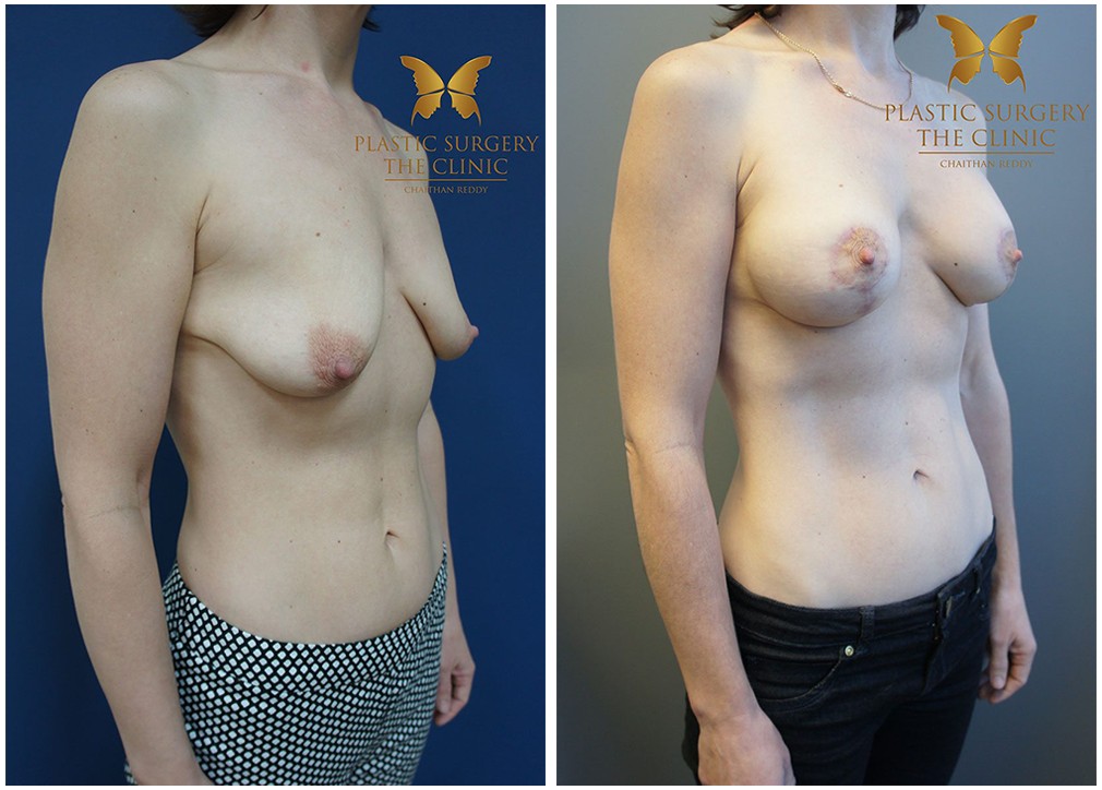 Breast augmentation with lift surgery 19, Dr Reddy Sydney