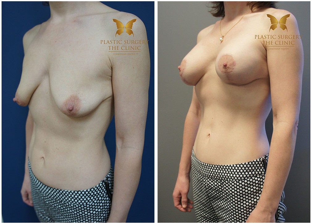 Before and after breast augmentation with lift surgery 21, Dr Reddy plastic surgery Sydney