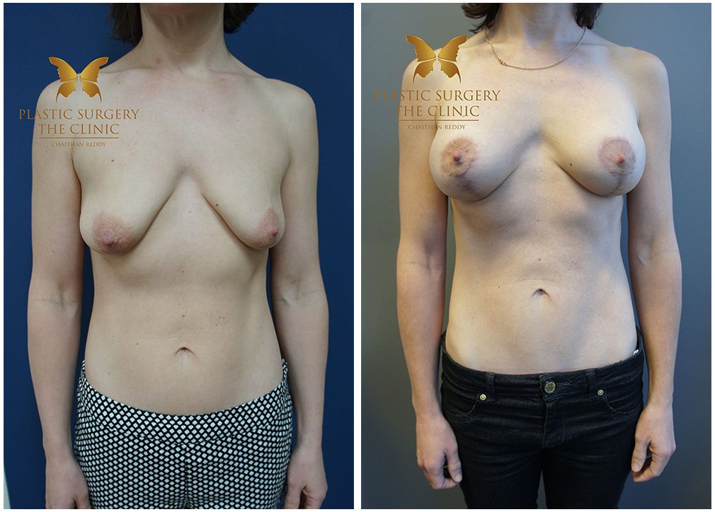 Breast augmentation Mastopexy results 22, Dr Chaithan Reddy