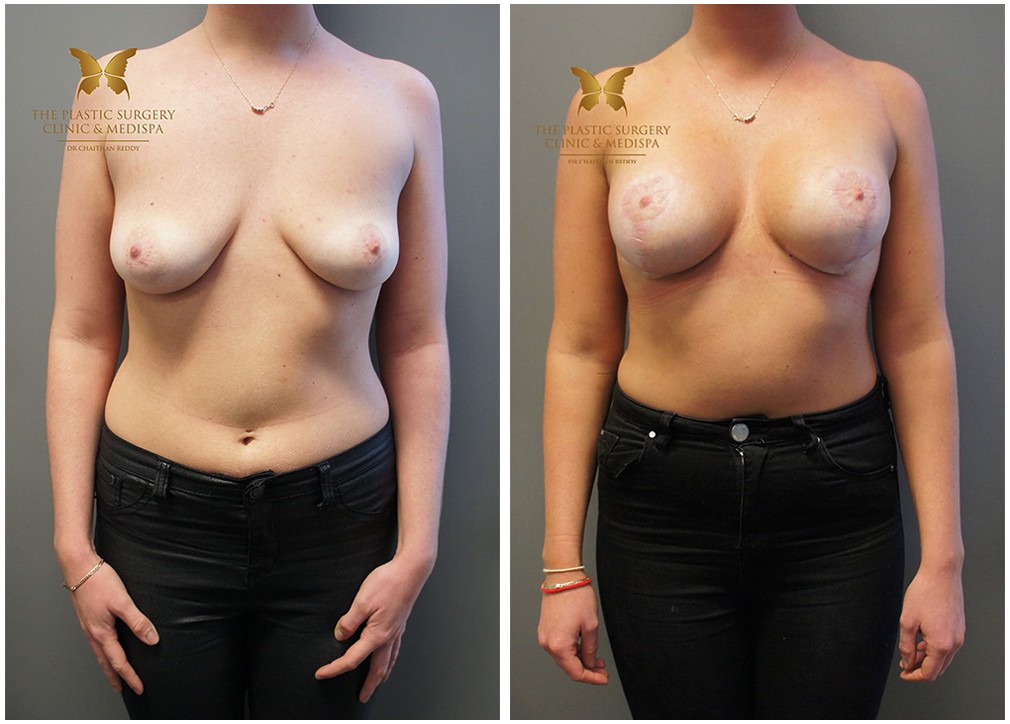 Breast implants and lift surgery, before and after 23, TPSC, front view