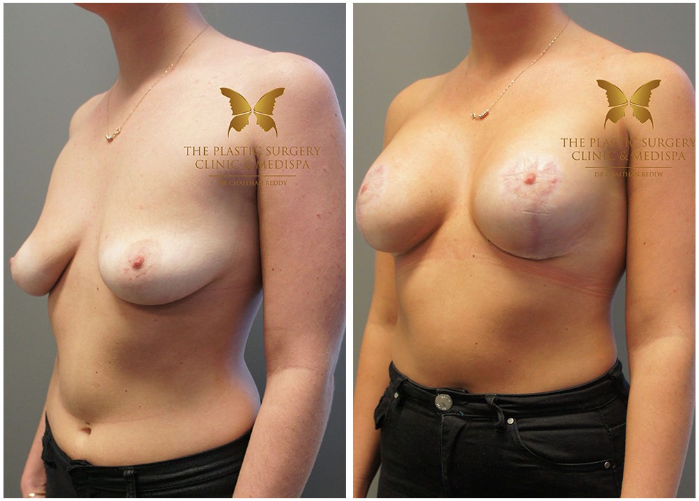 Patient before and after breast augmentation and lift 24, TPSC