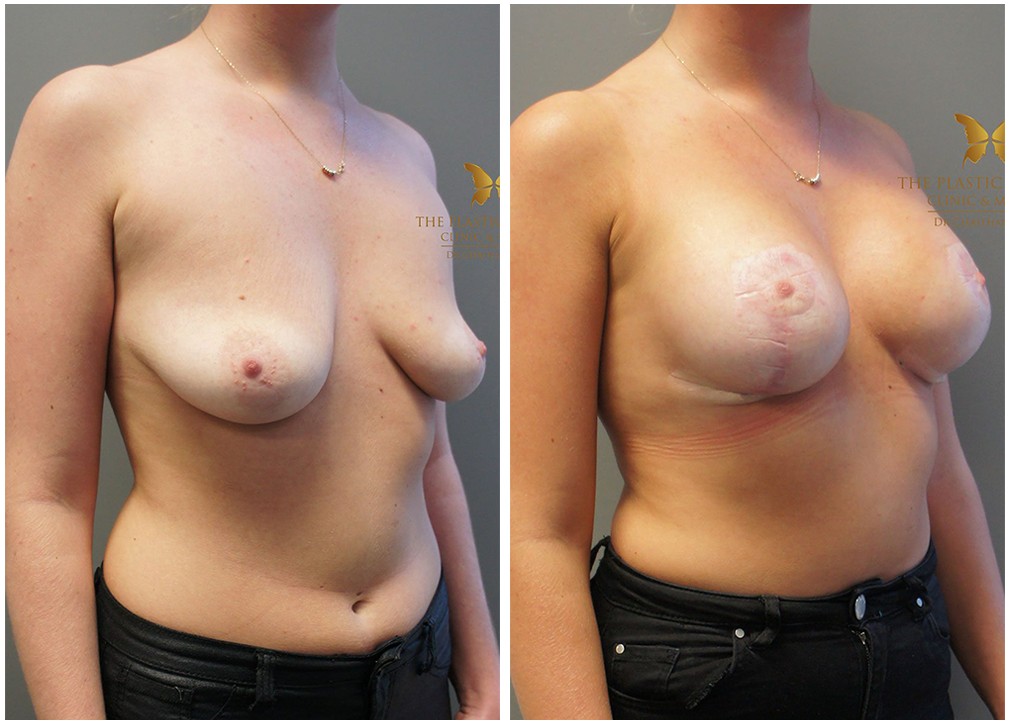 Before and afters 26, breast augmentation and lift, Dr Reddy