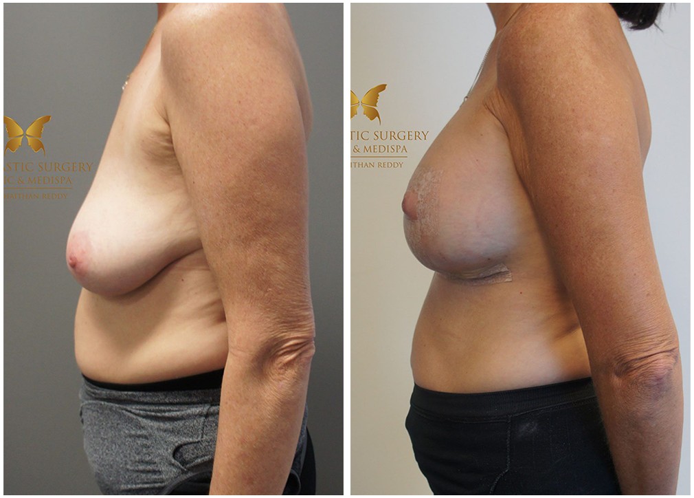 Patient before and after boob job with lift surgery 39, side view, TPSC Sydney &amp; Central Coast