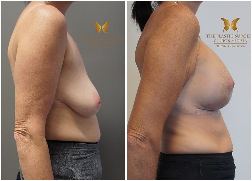 Patient before and after breast implants and lift surgery 40, Dr Reddy