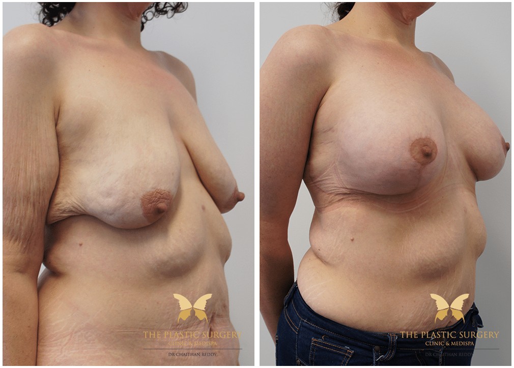 Breast implants and lift results 43, Dr Reddy Sydney