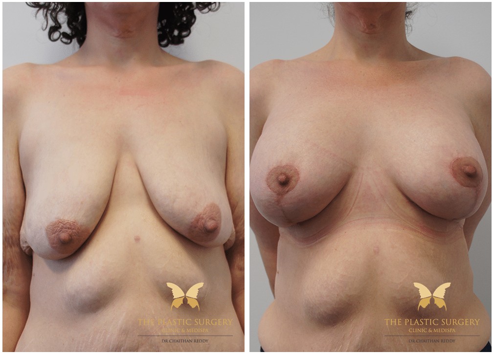 Patient before and after breast augmentation with implants 44, TPSC Sydney &amp; Central Coast