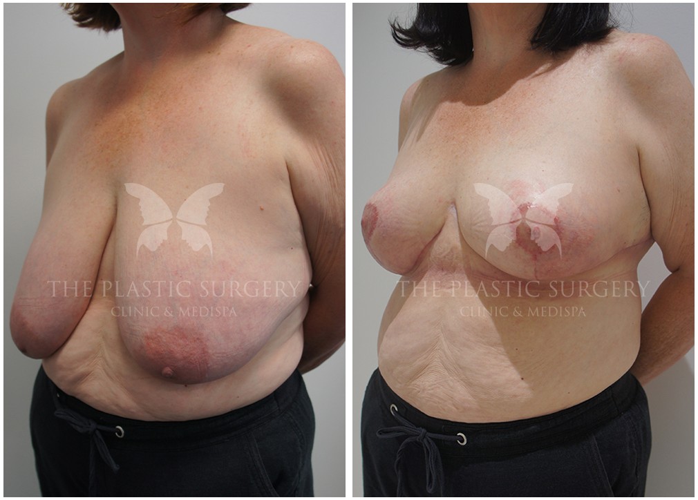 Breast augmentation with implants, before and after 46, TPSC