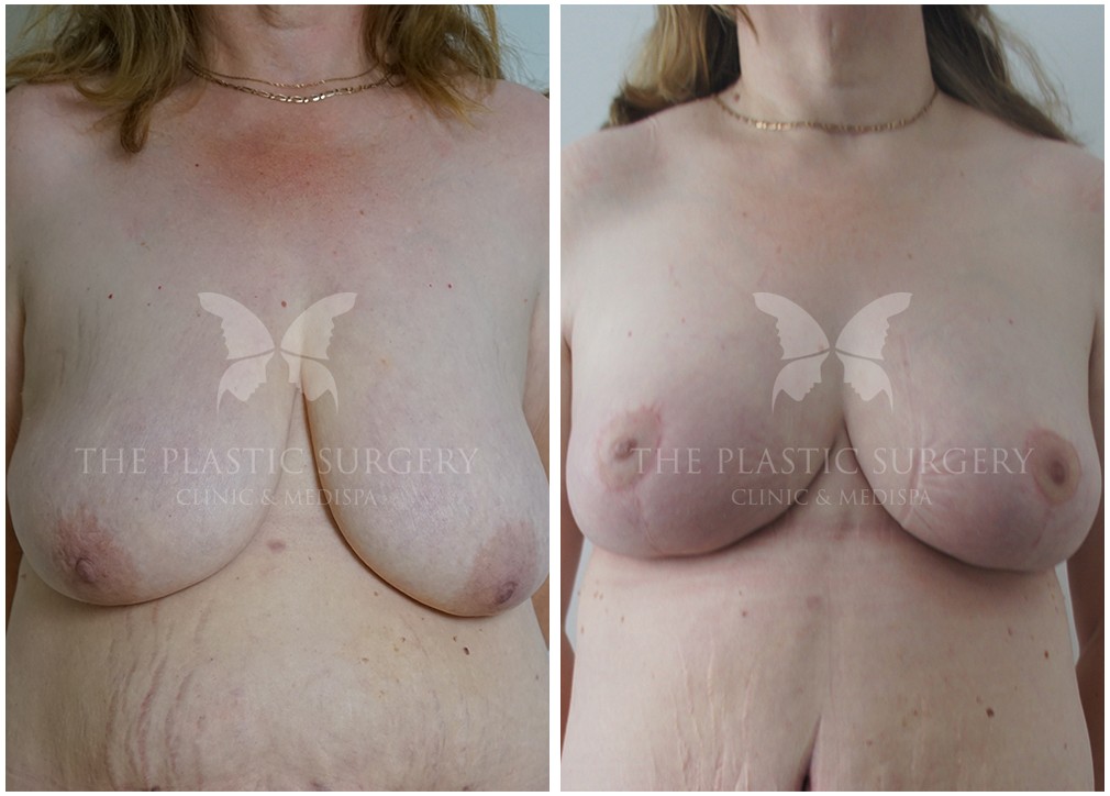 Before and after breast augmentation with lift surgery 50, TPSC