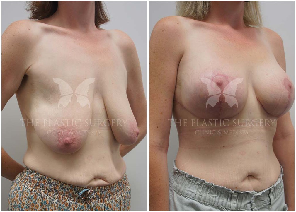 Patient before and afters 51, breast augmentation with lift, Dr Reddy plastic surgery Sydney