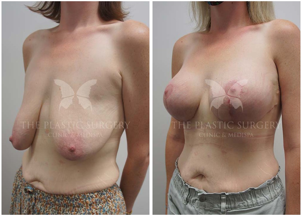 Patient before and after breast augmentation with lift, TPSC