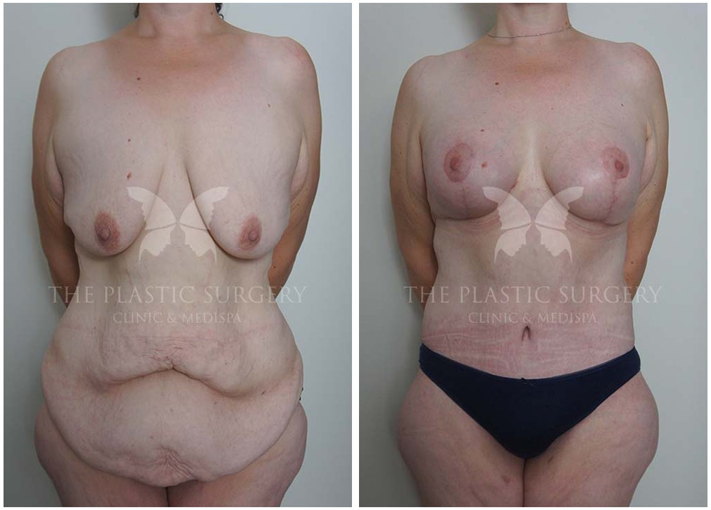 Mummy makeover before and after, breast augmentation Mastopexy and tummy tuck 56, Dr Reddy