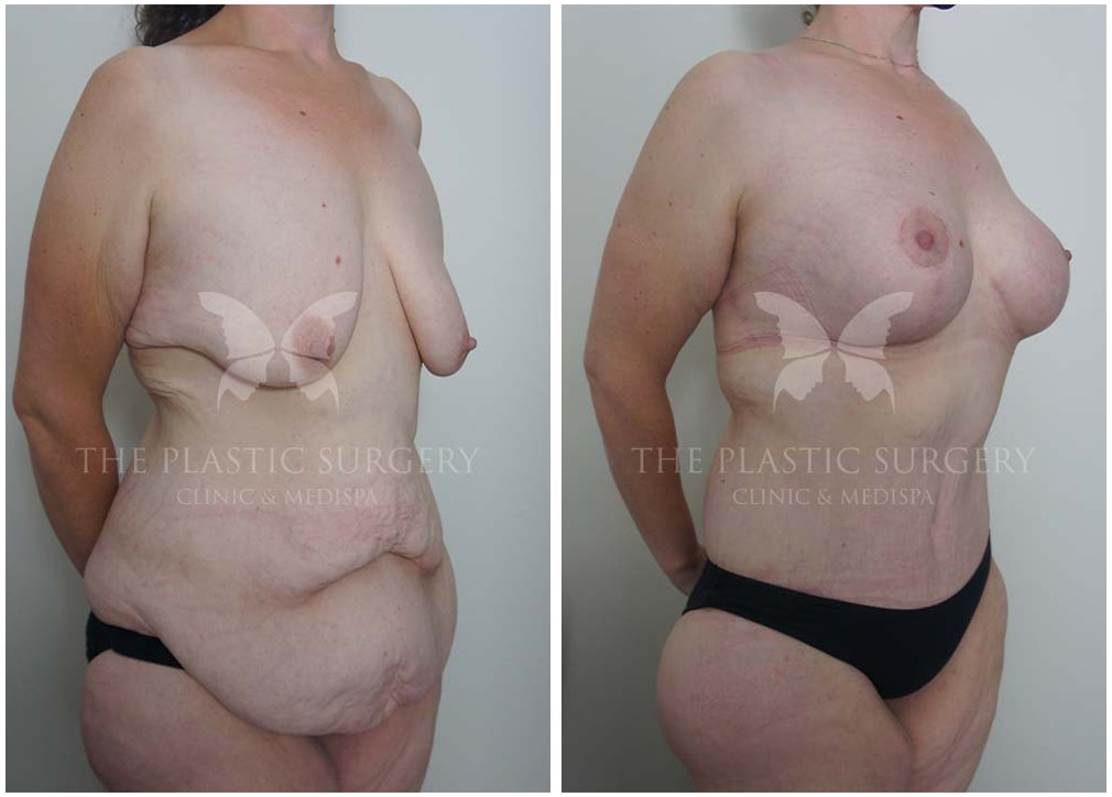 Patient before and after mummy makeover surgery (breast and abdominal procedures) 57, TPSC Sydney